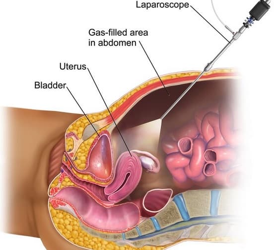 Laparoscopy