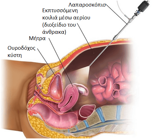 Λαπαροσκόπηση