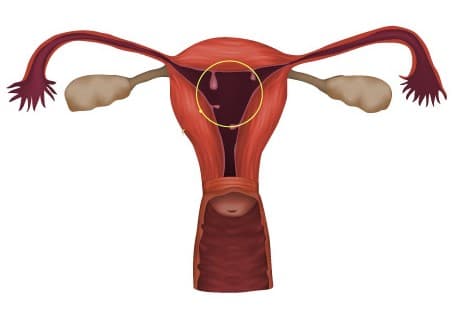 Ενδομήτριος πολύποδας