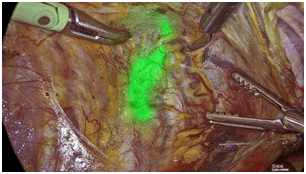 Φθορισμός ICG — ανίχνευση λεμφαγγείου