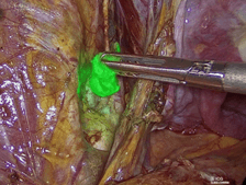 Φρουρός λεμφαδένας υπό NIR φωτισμό