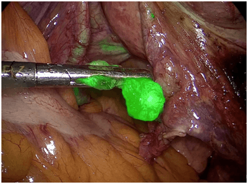 Αφαίρεση φθορίζοντος φρουρού λεμφαδένα