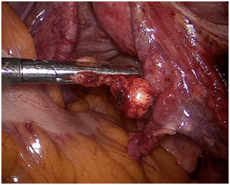 Φρουρός λεμφαδένας μετά αφαίρεση